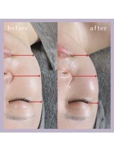 エクラ 天神店(ecla)/リフトアップ　インディバ