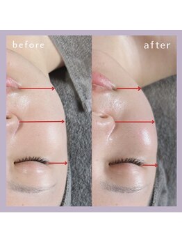 エクラ 天神店(ecla)/リフトアップ　インディバ