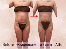 ハナ チュチュ(Hana chuchu)/セル脂肪撲滅コース　１２回目