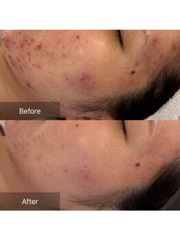 マインエム(mine.m)/繰り返しニキビ/肌質改善