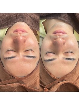 ミナアズアシリ(MINA as asir)/水素パック症例写真