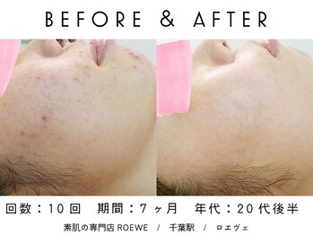 ロエヴェ(ROEWE)/ニキビ改善・毛穴ケア・肌質改善