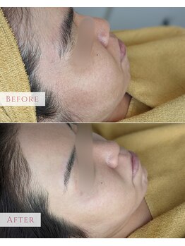 マシェリ(MA CHERIE)/フェイシャルWAX