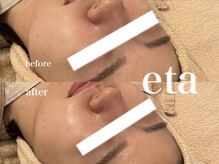 エタ(eta)/乳酸ピーリング1回での変化