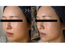 メルト 中目黒(Melt.)/＊ララピール