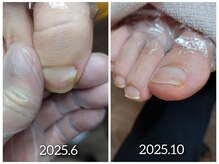 爪切り屋 足楽/【爪の割れ・カケ】