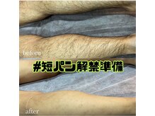 エリクサー 太田店(Elixir)/足脱毛