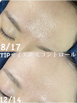 アリス(ALICE)/毛穴改善にはハーブピーリング