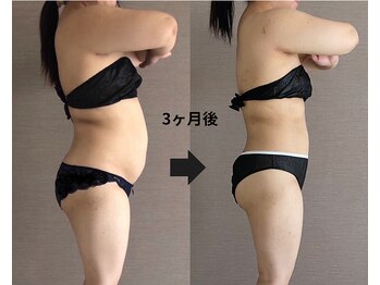 トータルビューティーサロンリア(Li'a)の写真/背中・お腹・二の腕のハミ肉ケアに！キャビテーション&極上リンパマッサージで夏までに理想のボディをGET！