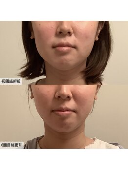 エムベル(M.belle)/リフトアップマッサージ6回