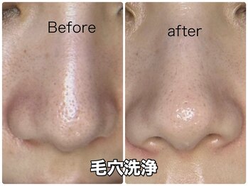 ルミネル 名古屋新栄(Luminelle)/毛穴洗浄