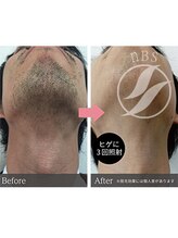 華みずき/メンズ脱毛