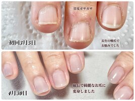 ジェルで自爪育成/深爪/噛爪育成