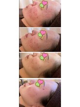 ビエル(Bielle)/赤み肌ケア