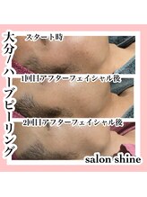 サロンシャイン(Salon Shine)/ハーブピーリング継続