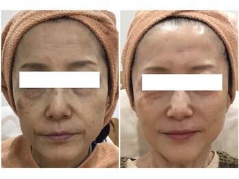 リッツ 所沢店/【Before/After】たるみ改善