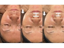 ディサイドロー(DECIDE L.A.W)/before after