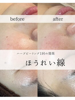 ワイシーハッチ(yc.hacci)/ハーブピーリング