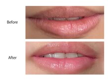 オーシャンブルー 福岡店(OCEAN BLUE フェイシャル&ボディ)/最新黒ずみケア《ローマピンク》