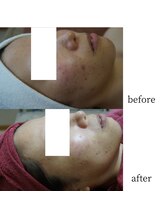 アップルミント/＜フェイシャル＞before・after