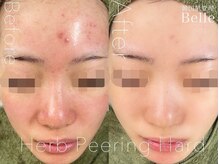 ベル 那覇おもろまち(Belle)/ハーブピーリング｜ニキビケア