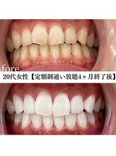 ホワイト 福岡博多店(WHITE)/ホワイトニングビフォーアフター