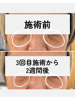 リジュベネーションサロン アリス(Alice)/レモンボトル眼窩脂肪実験