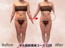 ハナ チュチュ(Hana chuchu)/セル脂肪撲滅コース　１２回目