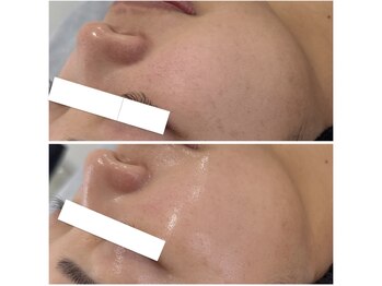 リートライ(Re Try)/陶器トリートメントプラズマニア