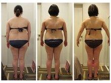パルティール(PARTIR)/◆痩身　症例写真