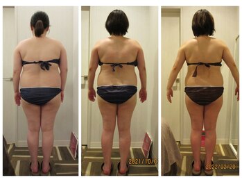パルティール(PARTIR)/◆痩身　症例写真