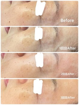 ビトタン 倉敷本店(+美to鍛)/ハーブピーリング/３回