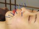 サンクエール 代官山鍼灸院(CINQ AILES)の写真/《究極のリフトアップ美容鍼》30代からのほうれい線の悩みにしっかりアプローチ！若々しいお肌へ導きます♪