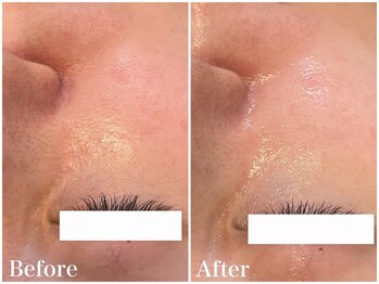 サロンドフェイス(Salon de Faith)/【ハーブピーリング】1回施術♪