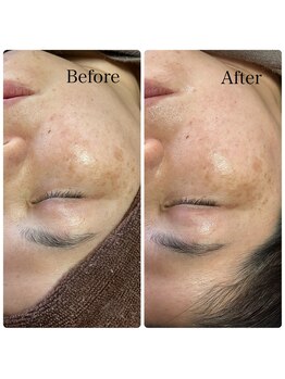 プルナモ(Purnama)/シミケア