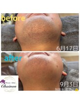 シェノン(Chainon)/メンズ髭脱毛