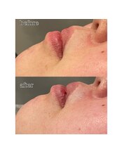 アデル 久留米(ADEL)/口周りの産毛、トーンアップ