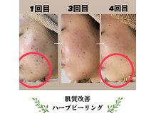 イミュ(Imyu.)の雰囲気（肌質改善ハーブピーリング。肌の深部からターンオーバーを促進。）