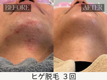 スキンジム(SKIN GYM)/脱毛でツラい剃刀負けから解放