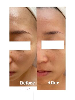 ソルア(SOLUA)/シミフェイシャル1回目施術