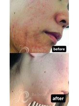 セレネ(SELENE)/頬顎周りの赤み、毛穴、酒さ