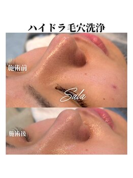 サラ/ハイドラ毛穴洗浄