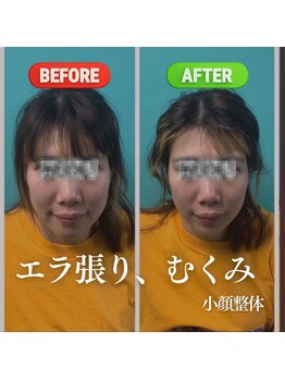 小顔になりたい