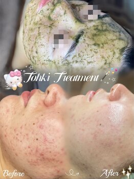 ラティーナ(Lattina)/陶肌トリートメント