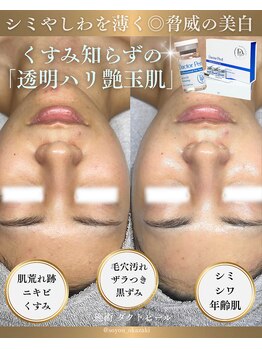 ソユ(SOYOU)/施術* ダクトピール