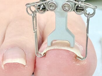 レヴィア(Revia)/巻き爪ケア