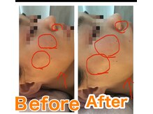 アンリール 旭川店(Anrire)/フェイシャル施術のお客様です！