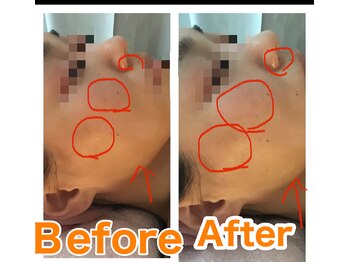 アンリール 旭川店(Anrire)/フェイシャル施術のお客様です!