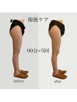 ファミーユ 名古屋店/【術後ケア】太もも吸引後ケア
