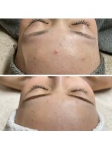 カンフリエ 吉野ヶ里店(Camphrier)/ハーブピーリング